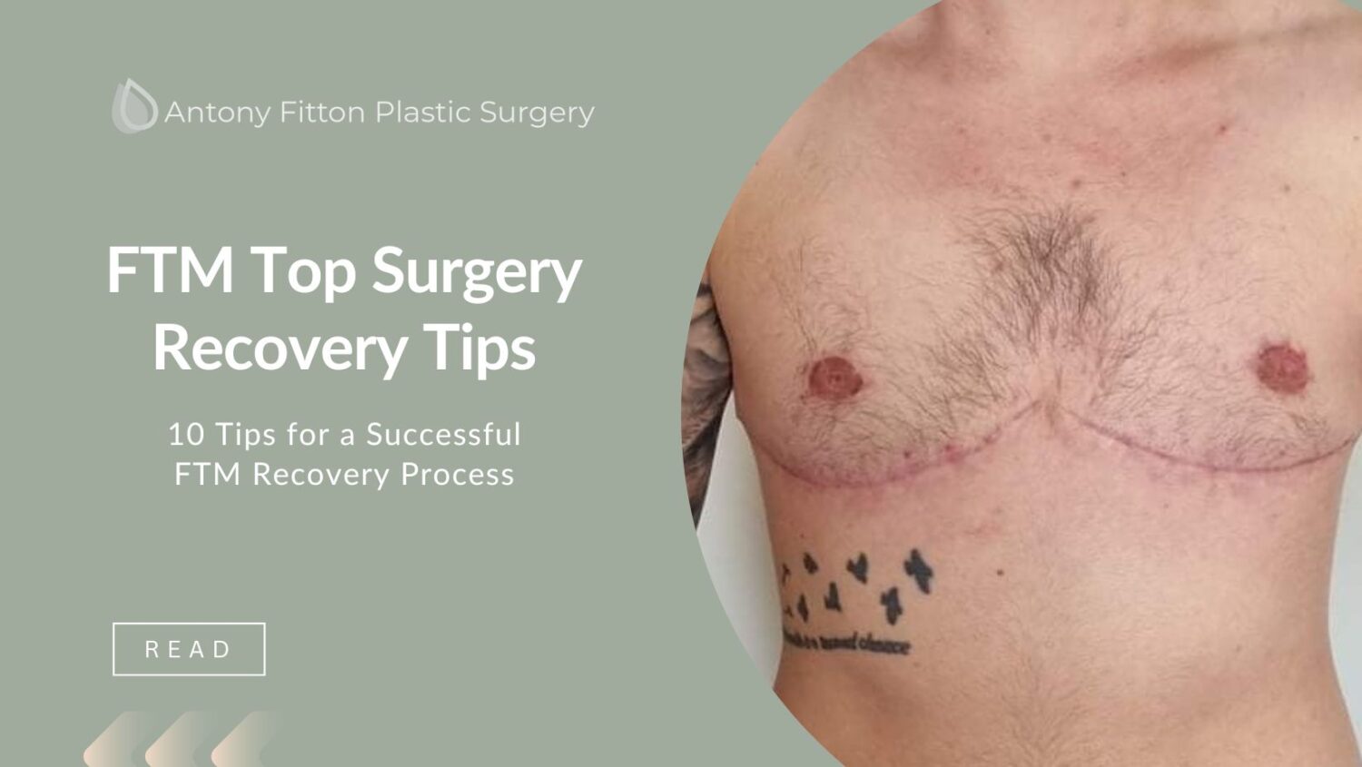 Top Surgery: Top Tips To Follow For Quick Recovery